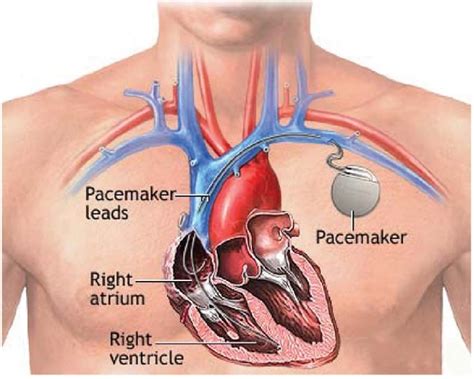 Pacemaker Implant - Center for Advanced Cardiac and Vascular Interventions