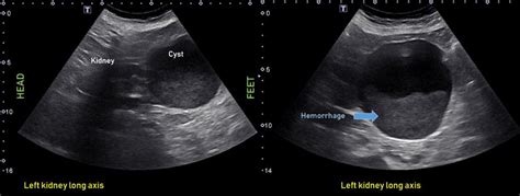 Ultrasound features of Kidney Cysts - Renal Fellow Network