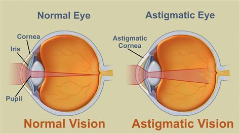 Astigmatism Causes, Symptoms, Diagnosis, Treatment, Prevention | Tips ...