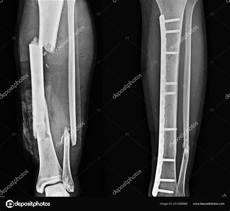 Tibia Fibula X Ray