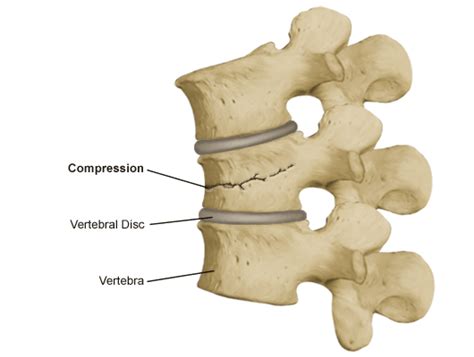 Compression Fracture - Shrewsbury, NJ & Toms River, NJ: Center for the ...