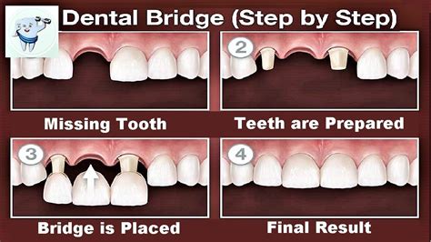 How Long Does A Tooth Bridge Last - How long does a dental bridge last ...