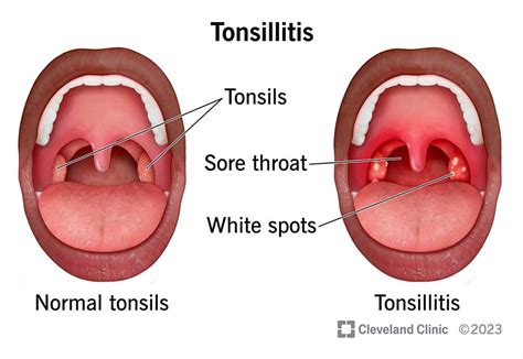 Strep Throat White Spots On Tonsils