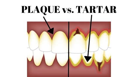 How To Remove PLAQUE vs.TARTAR