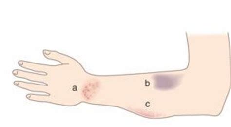 Ecchymosis - Definition, Pictures, Symptoms, Causes, Treatment