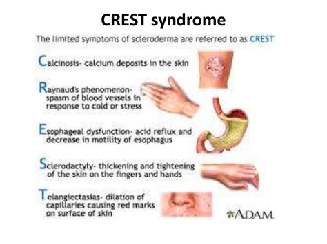 Progresive systemic sclerosis