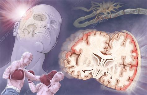 Traumatic Brain Injury - Stock Image - C024/9762 - Science Photo Library