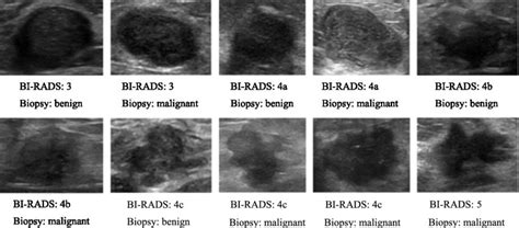 Breast Cancer Malignant Ultrasound Images