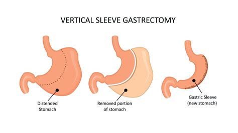 Vertical Sleeve Gastrectomy