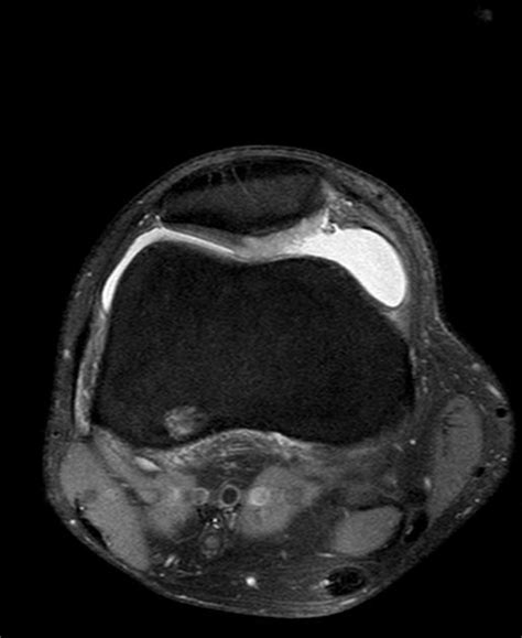 Modified Outerbridge grading of chondromalacia | pacs