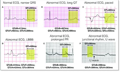 Normal Ecg Heart Rate Calculation - Photos Idea