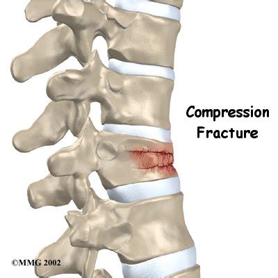 Spinal Compression Fracture | Singapore Sports & Orthopaedic Surgeon