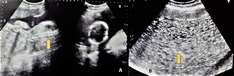 Cureus | Sad Fetus Syndrome: Partial Molar Pregnancy with a Live Fetus