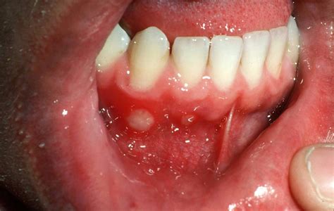 Aphthous stomatitis, aphthous ulcer causes & aphthous stomatitis treatment