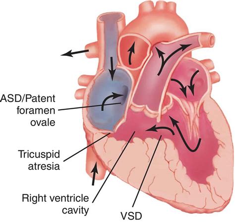 Tricuspid atresia causes, symptoms, diagnosis, treatment & prognosis