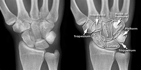 Trauma X-ray - Upper limb - Wrist