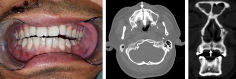 Transpalatal screw traction: a simple technique for the management of ...