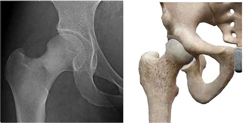 Femoral Neck Fracture Treatment