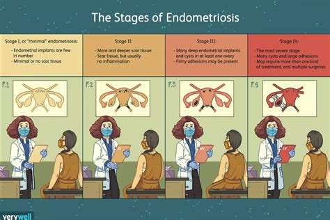 ¿Cuáles son las etapas de la endometriosis?