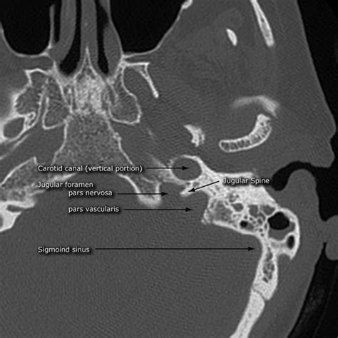 Jugular foramen | Radiology Reference Article | Radiopaedia.org ...