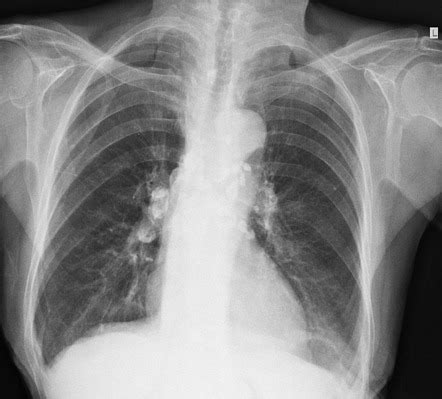 Pulmonary Tuberculosis Xray