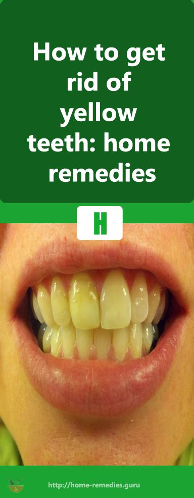 How to get rid of yellow teeth: home remedies | Home remedies, Remedies ...