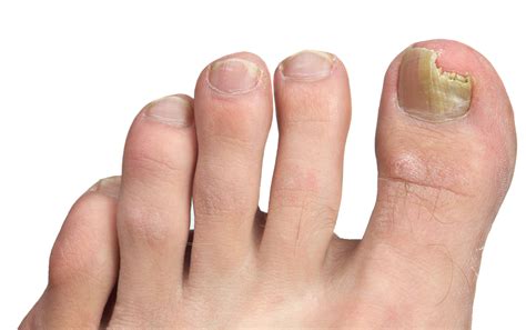 Toenail Fungus - Nathan H. Schwartz, DPM, podiatrist in Smyrna, GA