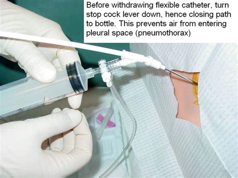 Pleural Tap Procedure