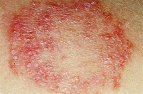 Skin Fungal Rash