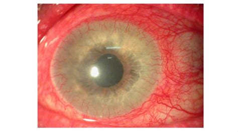 What Is Corneal Neovascularization? | OBN