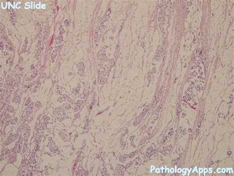 mucinous adenocarcinoma pathology