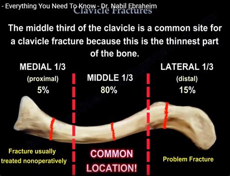 Clavicle Fracture Grading