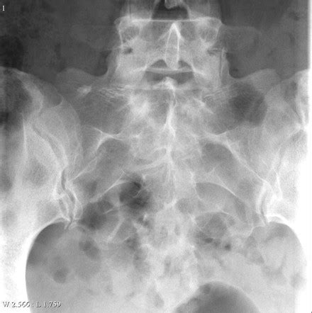 Sacrum Xray