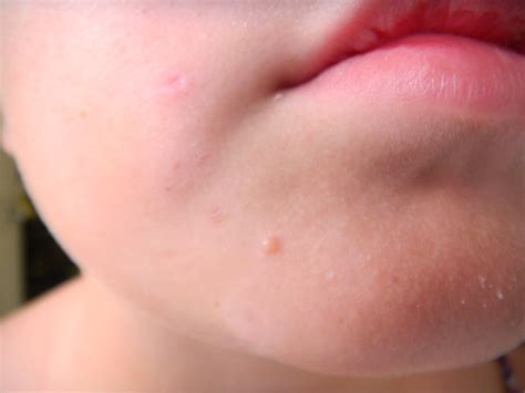 Facial Warts: Symptom, Cause and Treatment | New Health Advisor