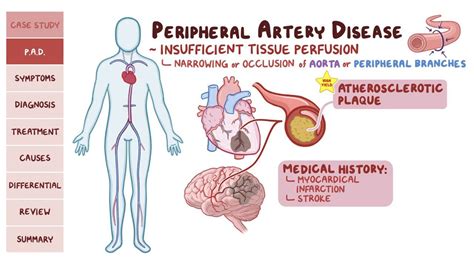 Peripheral Artery Disease: Video, Anatomy Definition, 40% OFF