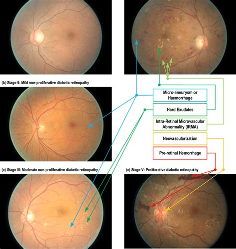 Fundoscopic images of different stages of diabetic retinopathy. (a ...