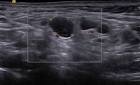 My supraclavicular lymph nodes swollen - gertwelcome