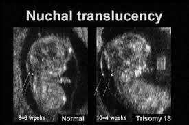 Little Baby Smith: Nuchal Translucency Scan