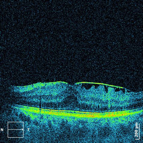 Epiretinal Membrane Surgery - Eyes Wide Bay