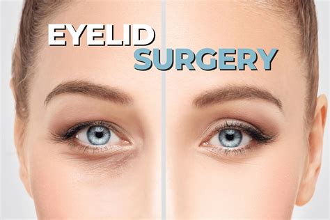 Having Eyelid Surgery - Things That You Should Know - AtoAllinks