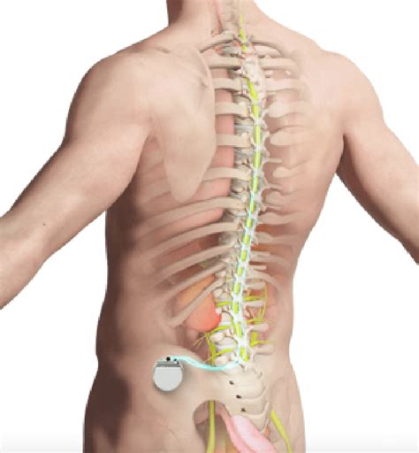 Spinal Cord Stimulator (SCS): Ripu Arora, MD, MBA: Board Certified Pain ...