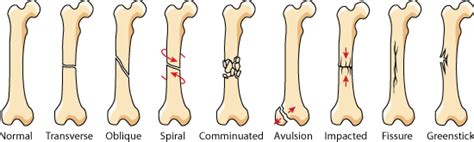 Fractures Broken Bones Urgent Care | ZipClinic