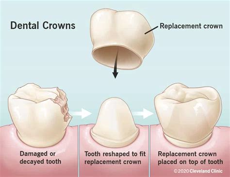 Veneers vs. dental crowns: Comparison and how to choose the best option ...