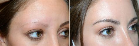 Eyebrow Transplantation Photos | Miami, FL | Patient 16773