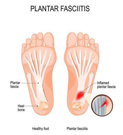 Plantar Fasciitis Massage Therapy Suffolk County NY