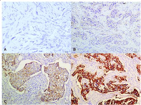 EGFR protein expression by immunohistochemistry. A: Negative EGFR ...