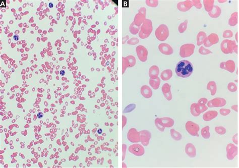 Megaloblastic Anemia Peripheral Smear