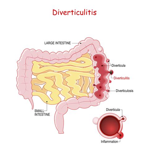 Diverticular Disease | GutCARE