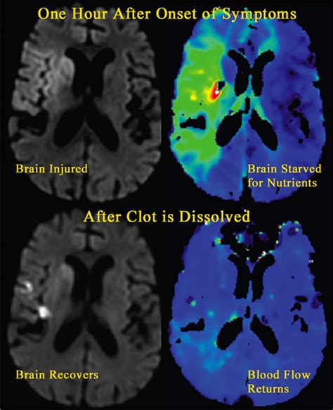 More Sensitive Stroke Detection | National Institutes of Health (NIH)