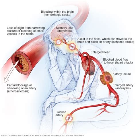 High blood pressure dangers: Hypertension's effects on your body - Mayo ...